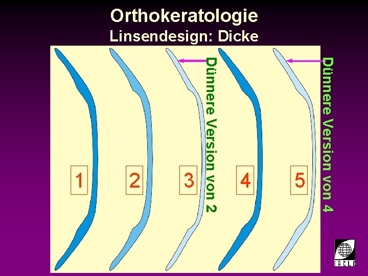 Orthokeratologie Linsendesign: Dicke 3 998700 -31 S. PPT 4 5 Dünnere Version von 4