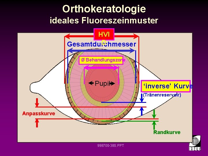 Orthokeratologie ideales Fluoreszeinmuster HVI D Gesamtdurchmesser Ø Behandlungszone Pupil ‘inverse’ Kurve (Tränenreservoir) Anpasskurve Randkurve