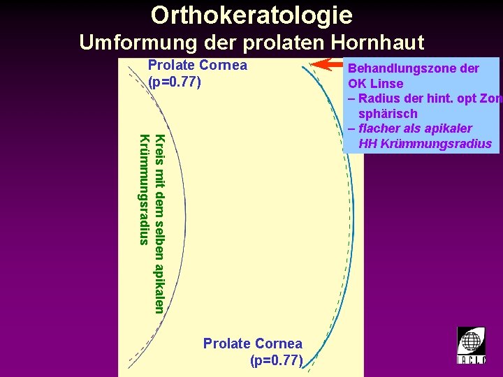 Orthokeratologie Umformung der prolaten Hornhaut Prolate Cornea (p=0. 77) Kreis mit dem selben apikalen