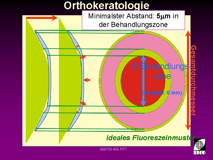 Orthokeratologie Minimalster Abstand: 5 m in der Behandlungszone Gesamtdurchmesser Ø Behandlungszone (Vorgabe: 6 mm)