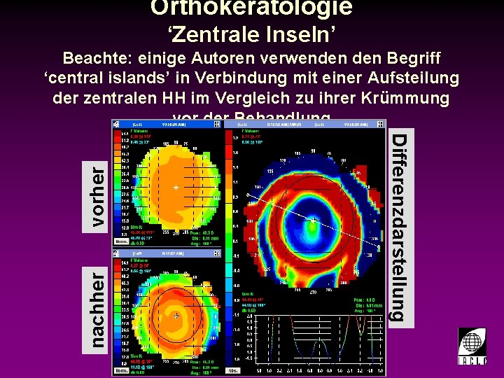 Orthokeratologie ‘Zentrale Inseln’ Beachte: einige Autoren verwenden Begriff ‘central islands’ in Verbindung mit einer
