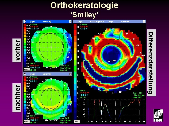 Orthokeratologie ‘Smiley’ nachher vorher Differenzdarstellung 998700 -46 S. PPT 