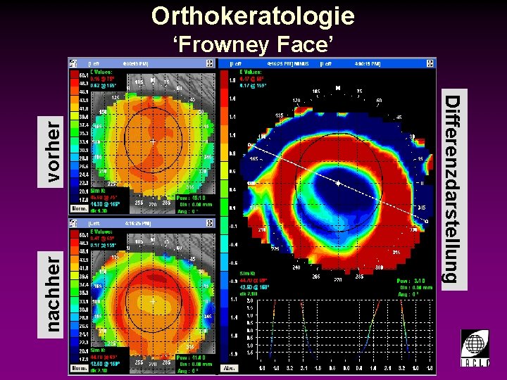 Orthokeratologie ‘Frowney Face’ nachher vorher Differenzdarstellung 998700 -73 S. PPT 