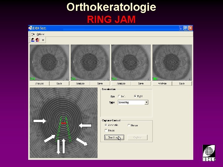 Orthokeratologie RING JAM 998700 -74 S. PPT 