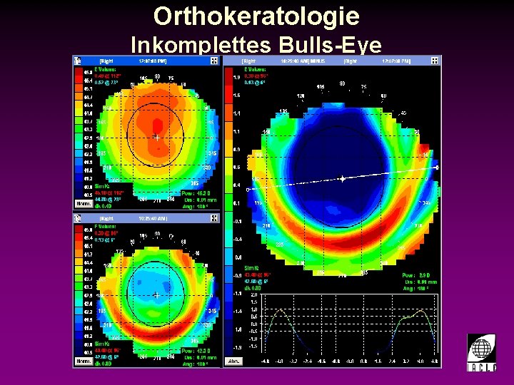 Orthokeratologie Inkomplettes Bulls-Eye 998700 -76 S. PPT 