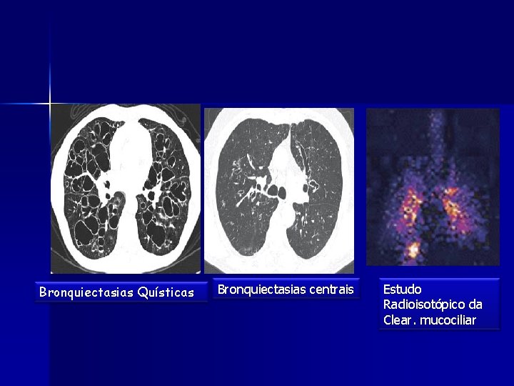 Bronquiectasias Quísticas Bronquiectasias centrais Estudo Radioisotópico da Clear. mucociliar 