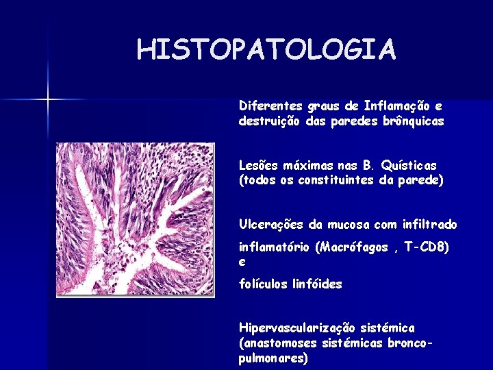 HISTOPATOLOGIA Diferentes graus de Inflamação e destruição das paredes brônquicas Lesões máximas nas B.