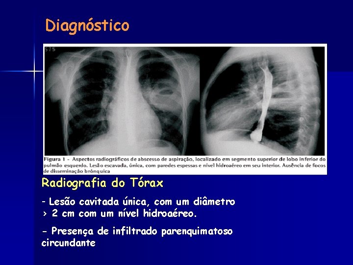 Diagnóstico Radiografia do Tórax - Lesão cavitada única, com um diâmetro > 2 cm