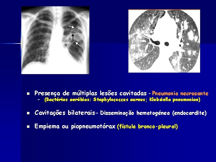 n Presença de múltiplas lesões cavitadas - Pneumonia necrosante n Cavitações bilaterais- Disseminação hematogénea