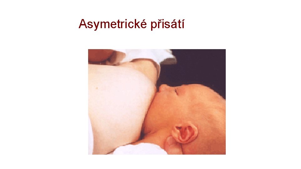 Asymetrické přisátí 