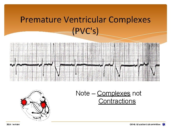 Premature Ventricular Complexes (PVC's) Note – Complexes not Contractions 2014 Version OBHG Education Subcommittee Premature Ventricular Complexes (PVC's) Note – Complexes not Contractions 2014 Version OBHG Education Subcommittee