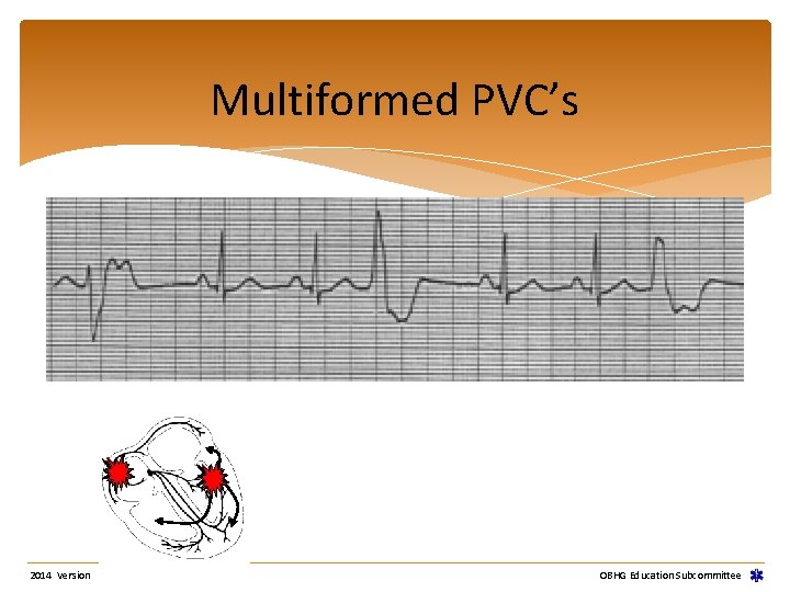 Multiformed PVC’s 2014 Version OBHG Education Subcommittee Multiformed PVC’s 2014 Version OBHG Education Subcommittee