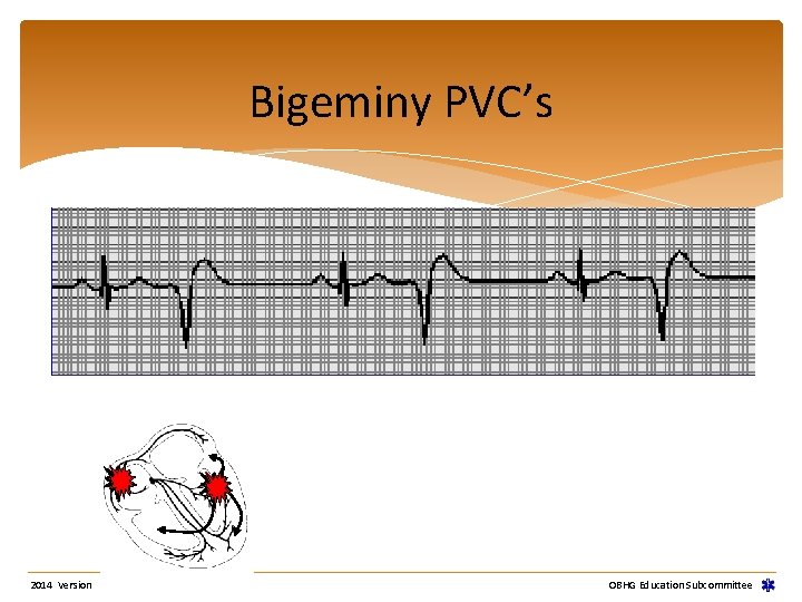 Bigeminy PVC’s 2014 Version OBHG Education Subcommittee Bigeminy PVC’s 2014 Version OBHG Education Subcommittee