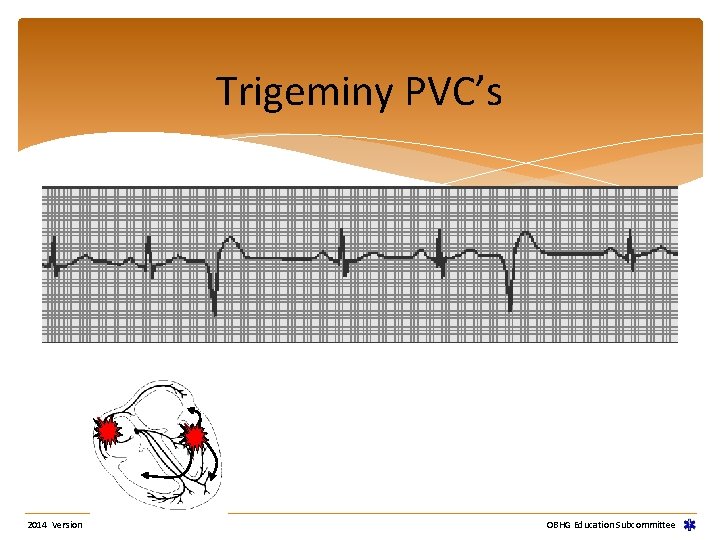 Trigeminy PVC’s 2014 Version OBHG Education Subcommittee Trigeminy PVC’s 2014 Version OBHG Education Subcommittee