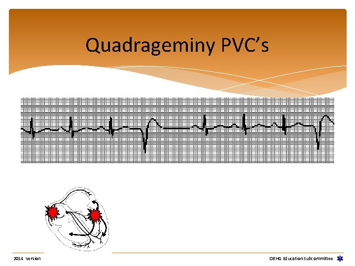 Quadrageminy PVC’s 2014 Version OBHG Education Subcommittee Quadrageminy PVC’s 2014 Version OBHG Education Subcommittee