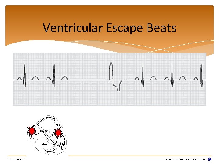 Ventricular Escape Beats 2014 Version OBHG Education Subcommittee Ventricular Escape Beats 2014 Version OBHG Education Subcommittee