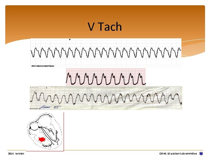 V Tach 2014 Version OBHG Education Subcommittee V Tach 2014 Version OBHG Education Subcommittee