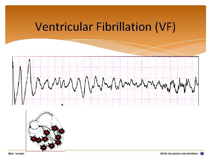 Ventricular Fibrillation (VF) 2014 Version OBHG Education Subcommittee Ventricular Fibrillation (VF) 2014 Version OBHG Education Subcommittee