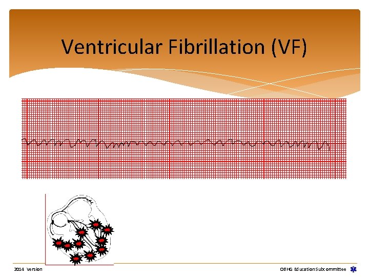 Ventricular Fibrillation (VF) 2014 Version OBHG Education Subcommittee Ventricular Fibrillation (VF) 2014 Version OBHG Education Subcommittee