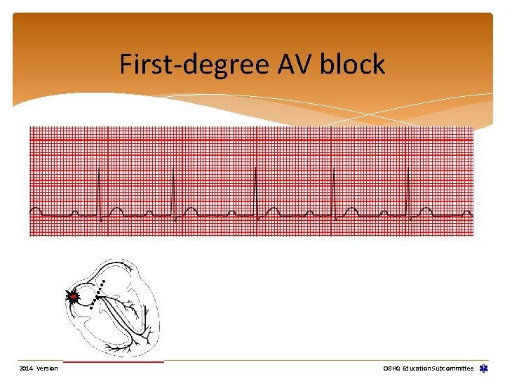 First-degree AV block 2014 Version OBHG Education Subcommittee First-degree AV block 2014 Version OBHG Education Subcommittee