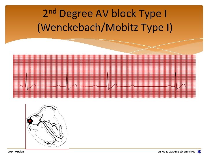 2 nd Degree AV block Type I (Wenckebach/Mobitz Type I) 2014 Version OBHG Education 2 nd Degree AV block Type I (Wenckebach/Mobitz Type I) 2014 Version OBHG Education