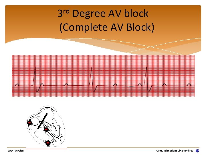 3 rd Degree AV block (Complete AV Block) 2014 Version OBHG Education Subcommittee 3 rd Degree AV block (Complete AV Block) 2014 Version OBHG Education Subcommittee