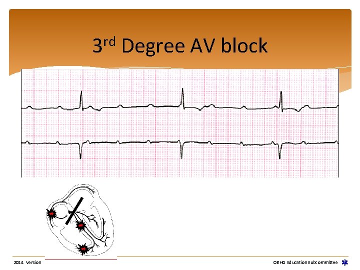 rd 3 2014 Version Degree AV block OBHG Education Subcommittee rd 3 2014 Version Degree AV block OBHG Education Subcommittee