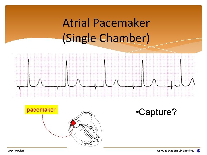 Atrial Pacemaker (Single Chamber) pacemaker 2014 Version • Capture? OBHG Education Subcommittee Atrial Pacemaker (Single Chamber) pacemaker 2014 Version • Capture? OBHG Education Subcommittee