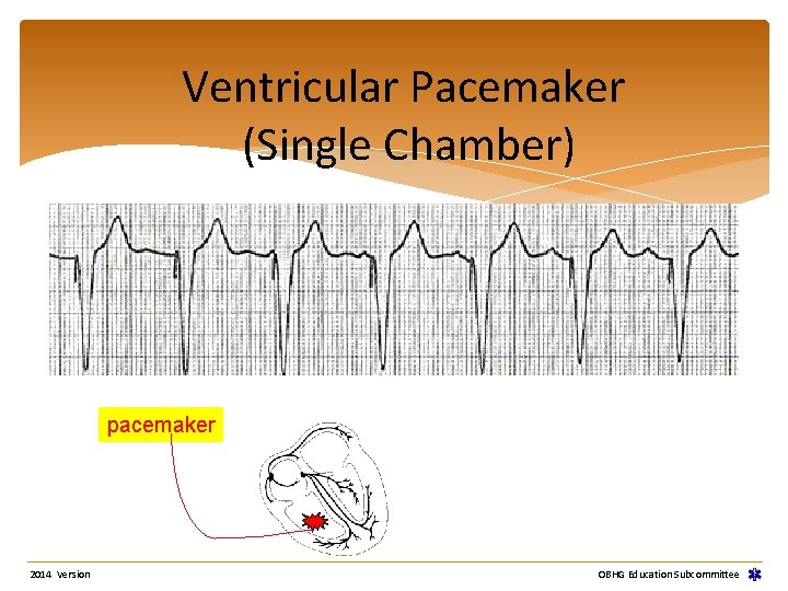 Ventricular Pacemaker (Single Chamber) pacemaker 2014 Version OBHG Education Subcommittee Ventricular Pacemaker (Single Chamber) pacemaker 2014 Version OBHG Education Subcommittee