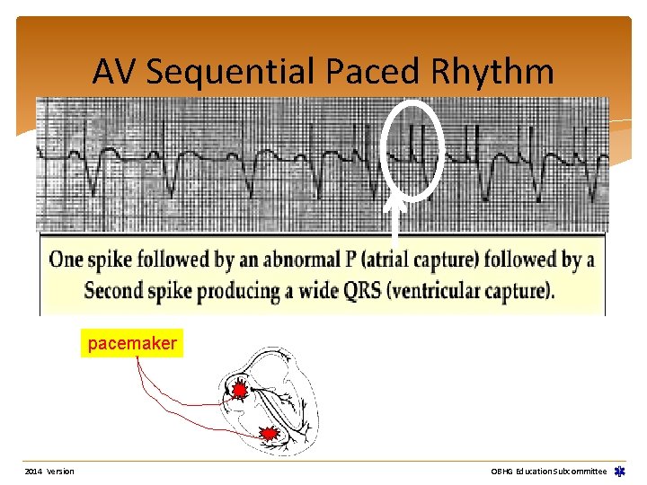AV Sequential Paced Rhythm pacemaker 2014 Version OBHG Education Subcommittee AV Sequential Paced Rhythm pacemaker 2014 Version OBHG Education Subcommittee