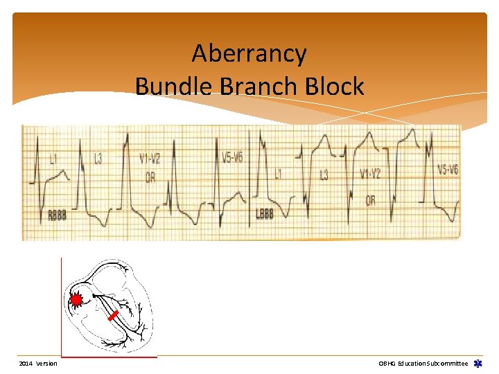 Aberrancy Bundle Branch Block 2014 Version OBHG Education Subcommittee Aberrancy Bundle Branch Block 2014 Version OBHG Education Subcommittee