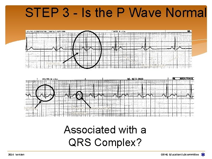 STEP 3 - Is the P Wave Normal Same Shape P wave with no STEP 3 - Is the P Wave Normal Same Shape P wave with no