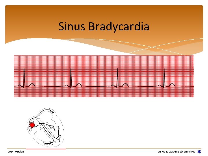 Sinus Bradycardia 2014 Version OBHG Education Subcommittee Sinus Bradycardia 2014 Version OBHG Education Subcommittee