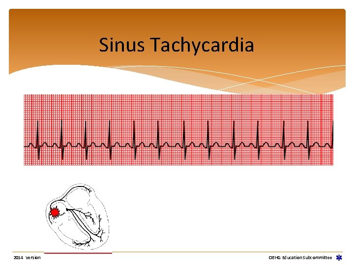 Sinus Tachycardia 2014 Version OBHG Education Subcommittee Sinus Tachycardia 2014 Version OBHG Education Subcommittee