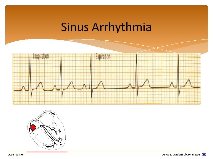 Sinus Arrhythmia 2014 Version OBHG Education Subcommittee Sinus Arrhythmia 2014 Version OBHG Education Subcommittee