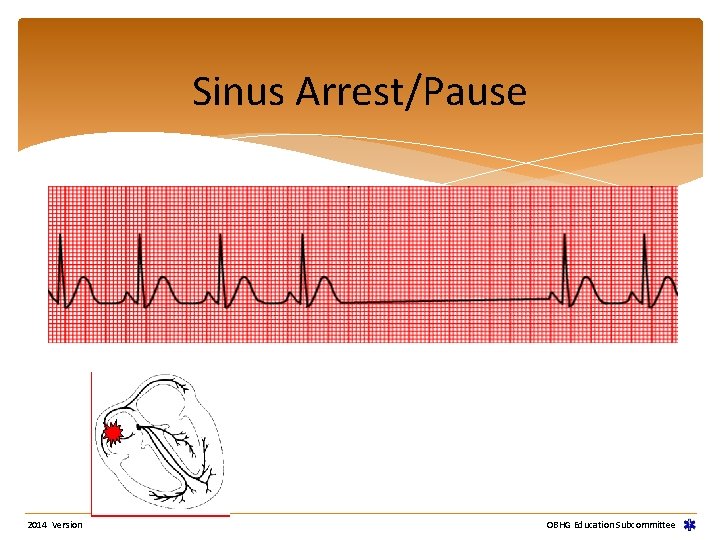 Sinus Arrest/Pause 2014 Version OBHG Education Subcommittee Sinus Arrest/Pause 2014 Version OBHG Education Subcommittee
