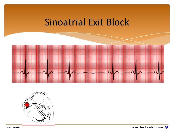 Sinoatrial Exit Block 2014 Version OBHG Education Subcommittee Sinoatrial Exit Block 2014 Version OBHG Education Subcommittee