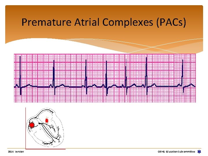 Premature Atrial Complexes (PACs) 2014 Version OBHG Education Subcommittee Premature Atrial Complexes (PACs) 2014 Version OBHG Education Subcommittee