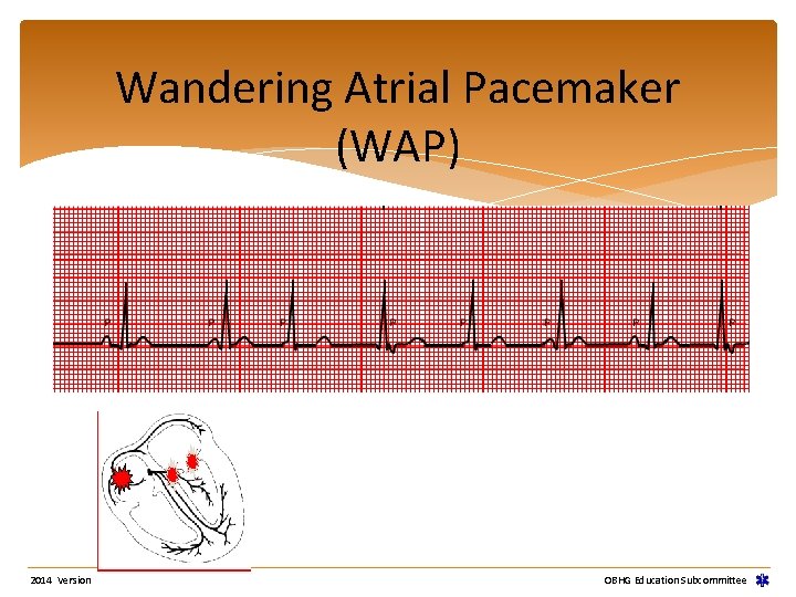 Wandering Atrial Pacemaker (WAP) 2014 Version OBHG Education Subcommittee Wandering Atrial Pacemaker (WAP) 2014 Version OBHG Education Subcommittee