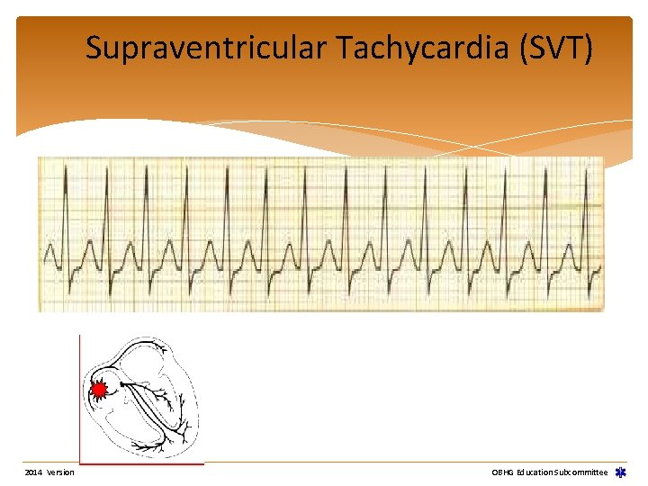 Supraventricular Tachycardia (SVT) 2014 Version OBHG Education Subcommittee Supraventricular Tachycardia (SVT) 2014 Version OBHG Education Subcommittee