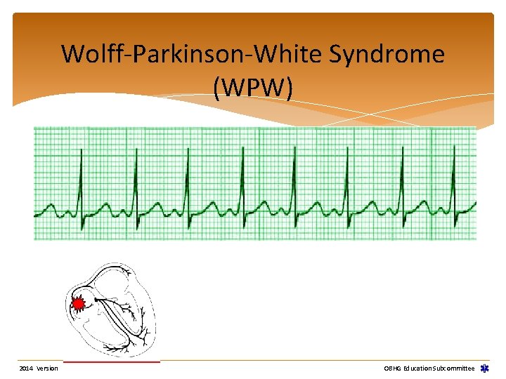 Wolff-Parkinson-White Syndrome (WPW) 2014 Version OBHG Education Subcommittee Wolff-Parkinson-White Syndrome (WPW) 2014 Version OBHG Education Subcommittee