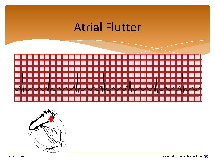 Atrial Flutter 2014 Version OBHG Education Subcommittee Atrial Flutter 2014 Version OBHG Education Subcommittee