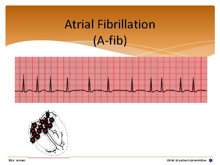 Atrial Fibrillation (A-fib) 2014 Version OBHG Education Subcommittee Atrial Fibrillation (A-fib) 2014 Version OBHG Education Subcommittee