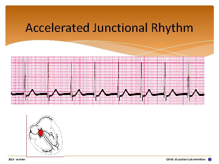 Accelerated Junctional Rhythm 2014 Version OBHG Education Subcommittee Accelerated Junctional Rhythm 2014 Version OBHG Education Subcommittee