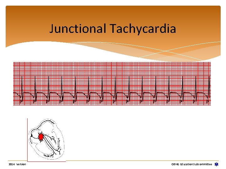 Junctional Tachycardia 2014 Version OBHG Education Subcommittee Junctional Tachycardia 2014 Version OBHG Education Subcommittee
