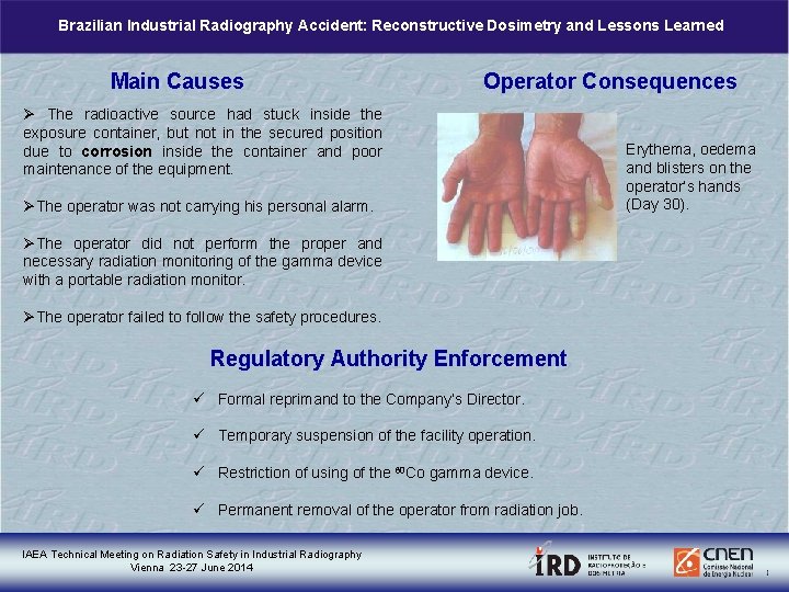 Brazilian Industrial Radiography Accident: Reconstructive Dosimetry and Lessons Learned Main Causes Operator Consequences Ø