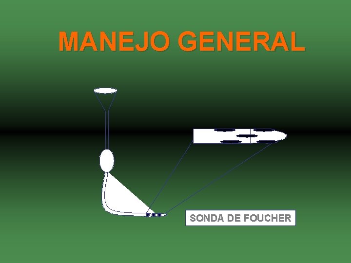 MANEJO GENERAL SONDA DE FOUCHER 