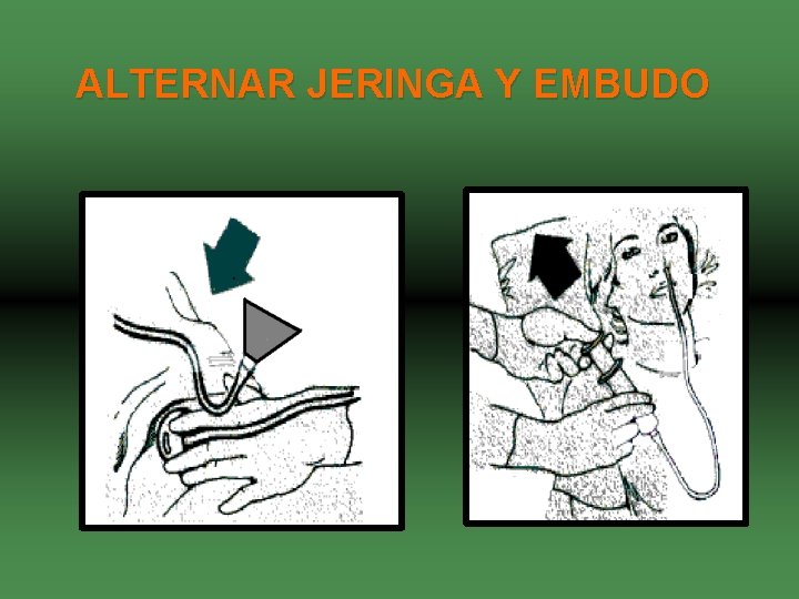 ALTERNAR JERINGA Y EMBUDO 