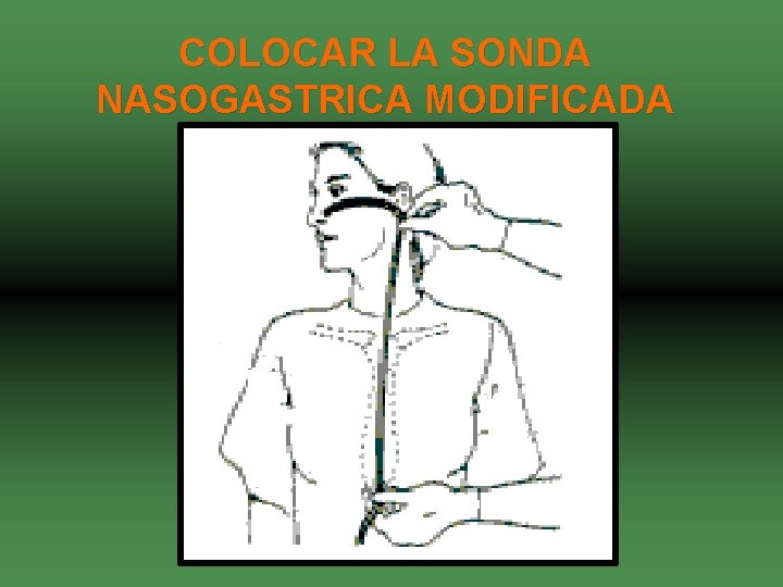 COLOCAR LA SONDA NASOGASTRICA MODIFICADA 