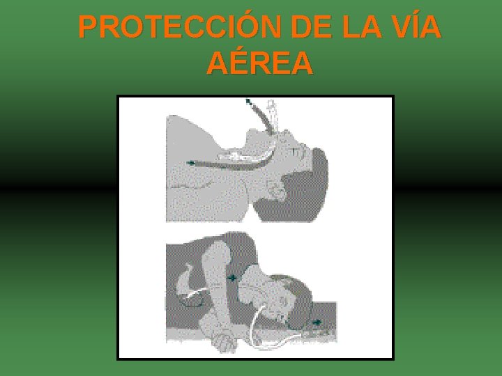 PROTECCIÓN DE LA VÍA AÉREA 